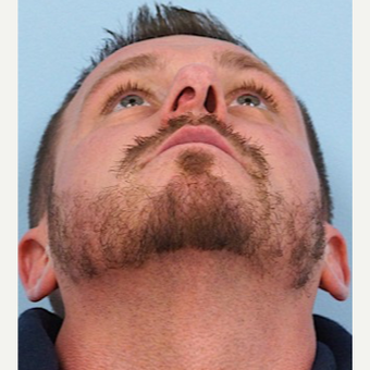 35-44 year old man treated with Rhinoplasty before 3691944