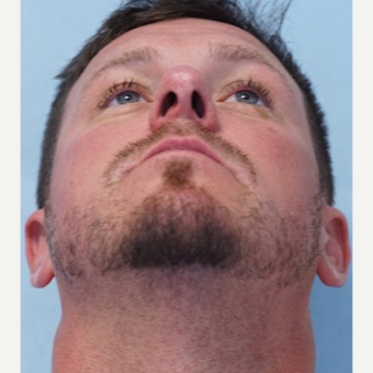 35-44 year old man treated with Rhinoplasty after 3691944