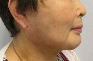 Chin Implant after 3164317