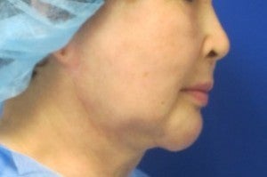 Chin Implant before 3164317