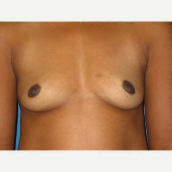Breast Augmentation on 39 year old patient before 1868196