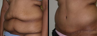 28 year old female tummy tuck before 1230388