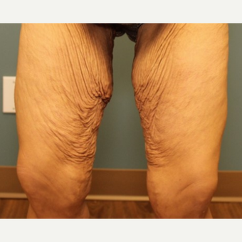 35-44 year old woman requesting Thigh Lift before 3031364