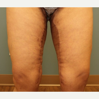 35-44 year old woman requesting Thigh Lift after 3031364