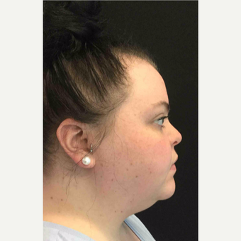 25-34 year old woman treated with Laser Liposuction to the Neck before 3200257