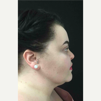 25-34 year old woman treated with Laser Liposuction to the Neck after 3200257