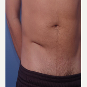 35-44 year old man treated with Scar Removal before 3705037