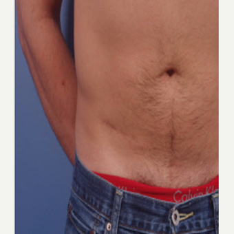 35-44 year old man treated with Scar Removal after 3705037