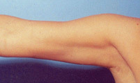 Arm Liposuction after 652130