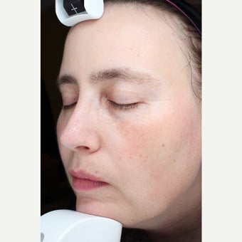 35-44 year old woman treated with Halo Laser after 2129471