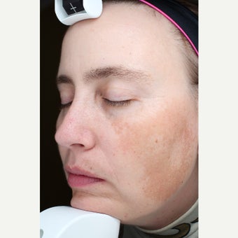 35-44 year old woman treated with Halo Laser before 2129471