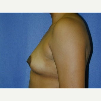 35-44 year old woman, weight 125-135 lbs, treated with Breast Augmentation 1711642