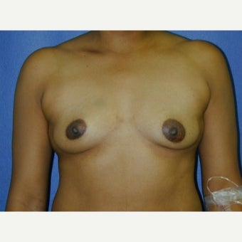 35-44 year old woman, weight 125-135 lbs, treated with Breast Augmentation before 1711642