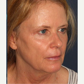 45-54 year old woman treated with Radiesse after 3230339