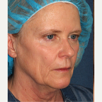 45-54 year old woman treated with Radiesse before 3230339