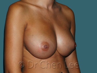 Nipple Inversion 930311