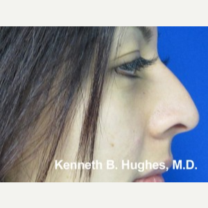 Rhinoplasty before 2990565