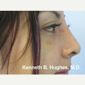 Rhinoplasty after 2990565