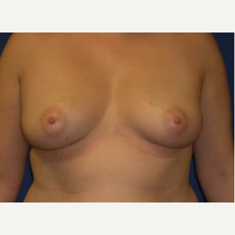 45-54 year old woman treated with Breast Augmentation before 3220003