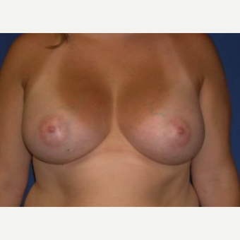 45-54 year old woman treated with Breast Augmentation after 3220003