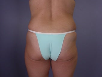 Bodylift after 653563