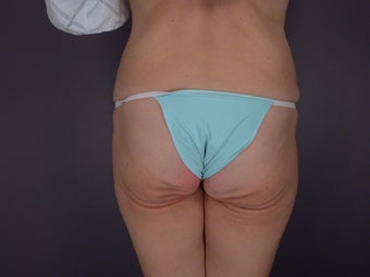 Bodylift before 653563