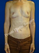 Breast Implant Removal, Breast Lift after 1014772