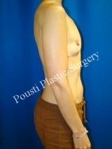 Breast Implant Removal, Breast Lift 1014772