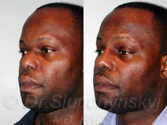 32 year old African American Male - Rhinoplasty 987246