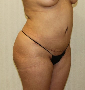 25-34 year old woman treated with Fat Transfer before 3163486