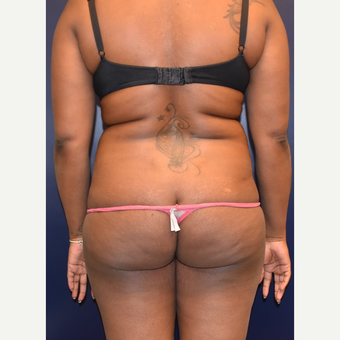 25-34 year old woman treated with Butt Augmentation before 3344414
