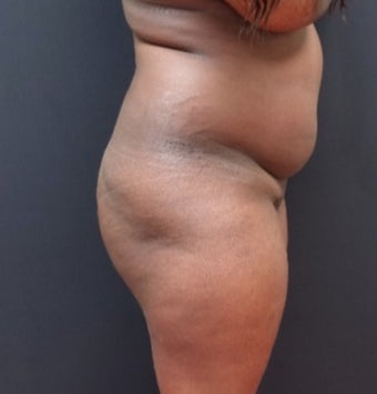 25-34 year old woman treated with Tumescent Liposuction before 3363774