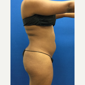 25-34 year old woman treated with Liposuction before 3142214