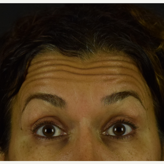 45 year old woman treated with Botox before 3691716