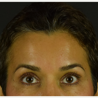 45 year old woman treated with Botox after 3691716