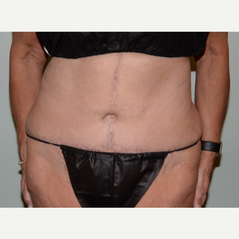 62 year old woman treated with Tummy Tuck after 3582854