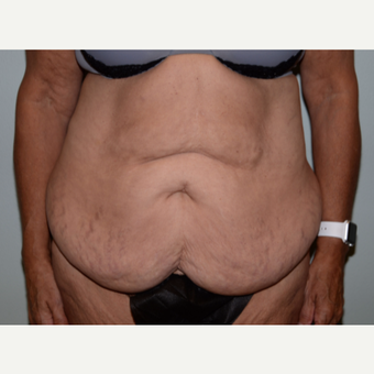 62 year old woman treated with Tummy Tuck before 3582854
