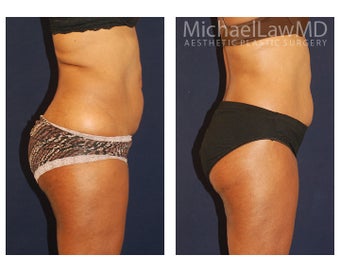Thigh Lift before 1324024