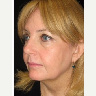 55-64 year old woman treated with Non Surgical Face Lift after 3181010