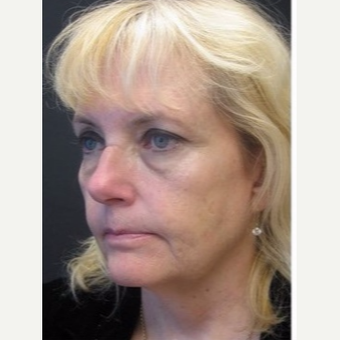 55-64 year old woman treated with Non Surgical Face Lift before 3181010