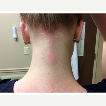 25-34 year old woman treated with Laser Tattoo Removal after 3292548