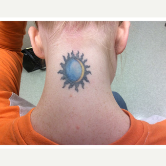 25-34 year old woman treated with Laser Tattoo Removal before 3292548