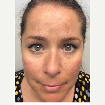 35-44 year old woman treated with Melasma Treatment before 2270359