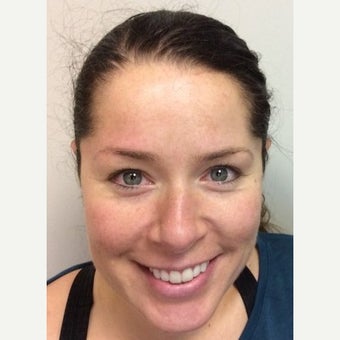 35-44 year old woman treated with Melasma Treatment after 2270359