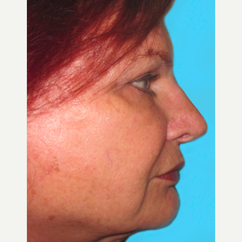 Rhinoplasty after 3814287