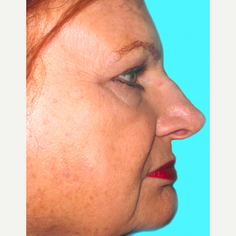 Rhinoplasty before 3814287