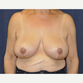 55-64 year old woman treated with Breast Reduction 1688376