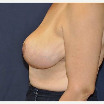 55-64 year old woman treated with Breast Reduction after 1688376