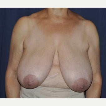 55-64 year old woman treated with Breast Reduction 1688376