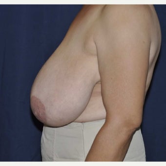 55-64 year old woman treated with Breast Reduction before 1688376